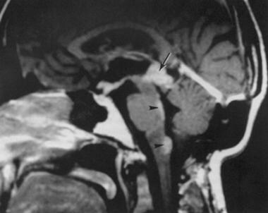 MRI of a 44-year-old woman 10 years after resectio