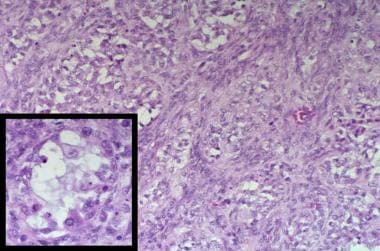 Juvenile granulosa cell tumor. Multiple follicles 