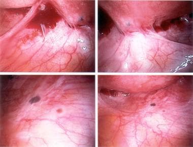 Scarring due to old disease and active endometrios