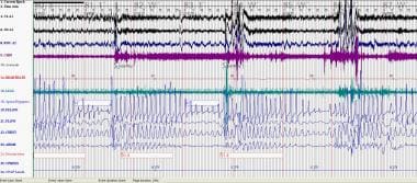 Central Sleep Apnea (CSA)