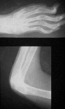 Radiographs of hand (top) and arm (bottom) of a pa