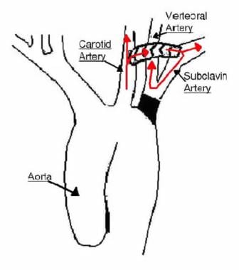 carotid subclavian transposition