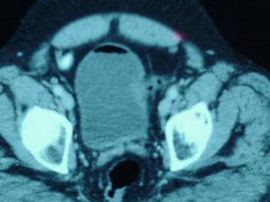 A CT scan one cut further inferiorly from the rela