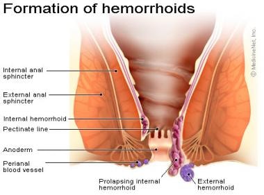 Hemorrhoids. Anatomy of external hemorrhoid. Image