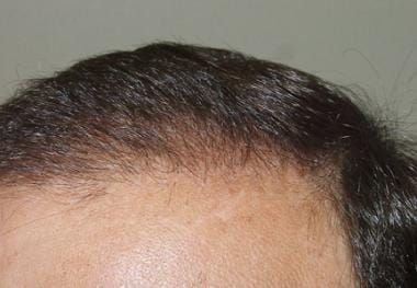 Case 1. Close-up view of the hairline of a patient