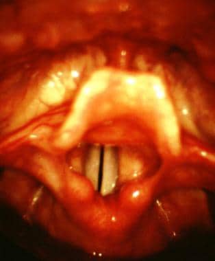 Laryngoscopic view of the larynx. Note the followi