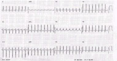 Myocardial Infarction in Childhood. Electrocardiog