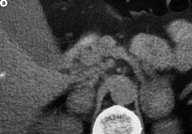 Computed tomography scan shows enlarged adrenal gl