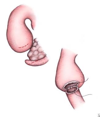 Pediatric duodenal atresia. Side-to-side duodenodu