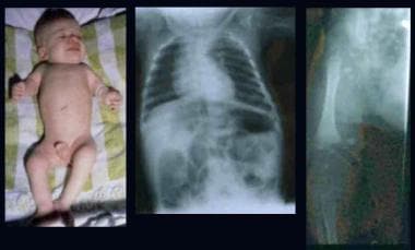 Infant with rhizomelic form of chondrodysplasia pu