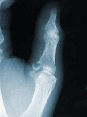 Lateral radiograph displaying a gamekeeper's fract