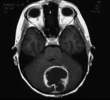 This MRI shows a pilocytic astrocytoma of the cere