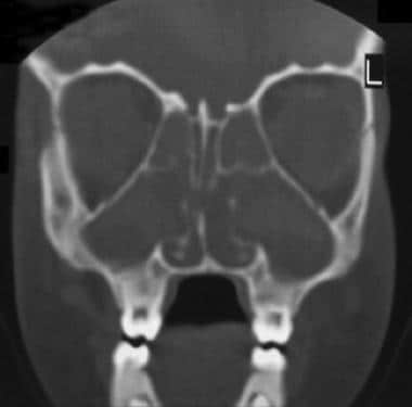Coronal section through the ethmoid maxillary sinu