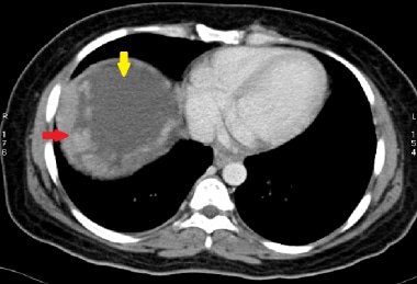 This 58-year-old patient presented with abdominal 