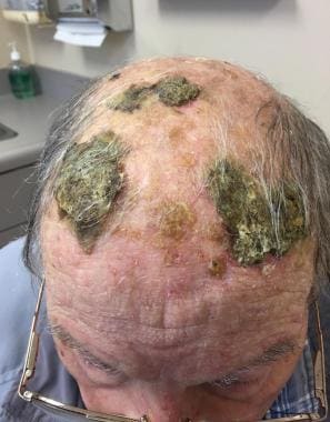 Erosive pustulosis of the scalp prior to curettage