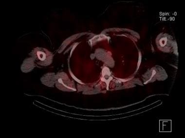 Sestamibi parathyroid scan with SPECT scan showing