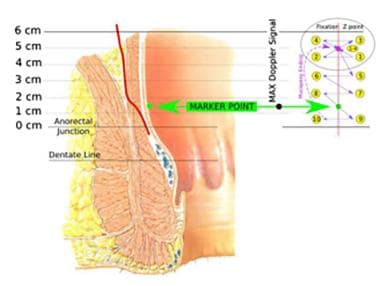 Transanal hemorrhoidal artery ligation (HAL). Mark