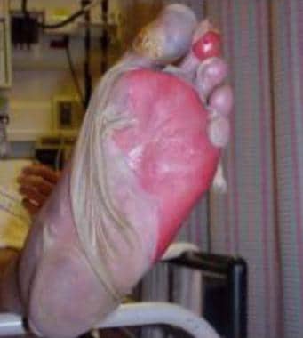 Sheetlike desquamation on the foot in a patient wi