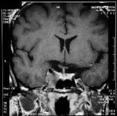 A T1-weighted, coronal MRI. 