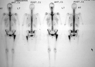 reticulum cell sarcoma x ray