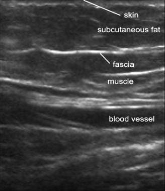 Ultrasound image of normal soft tissue. 