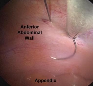 String is placed around appendix. 