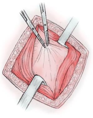Open appendectomy. Transversalis fascia and perito