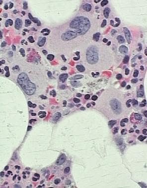 Pathology of Acute Myeloid Leukemia With Myelodysp