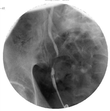 Retrograde ureterogram: Fluoroscopic spot image ob