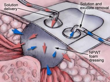 dean downey negative pressure wound therapy