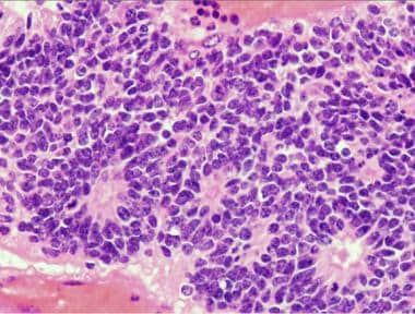 Pathology of Embryonal Tumors. The ependymoblastom