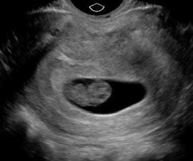 Normal fetal pole within a gestational sac. 