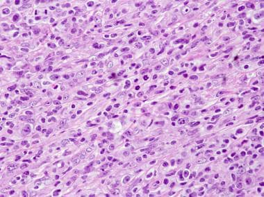 Anaplastic large cell lymphoma. The markedly atypi