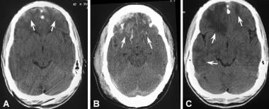 Resolution of a brain contusion. (A) Axial CT scan