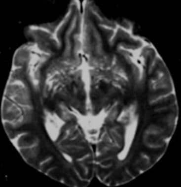 T2-weighted axial magnetic resonance image demonst