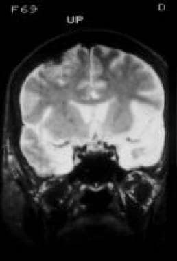 Magnetic resonance image depicting herpes encephal