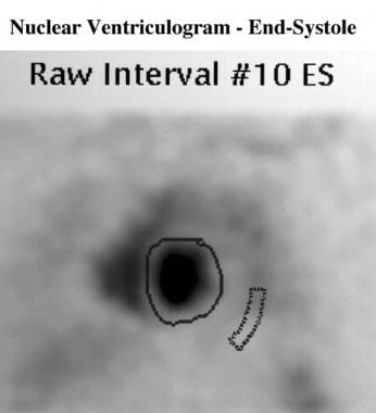 Nuclear image of the heart in end systole, with th