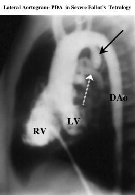 Lateral left ventriculogram in a patient with tetr