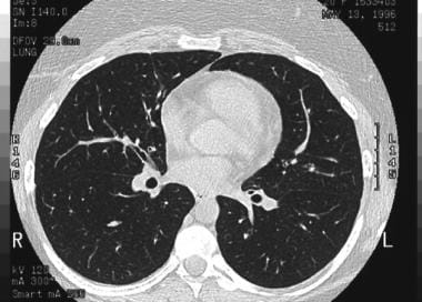 High-resolution CT scan of the thorax obtained dur