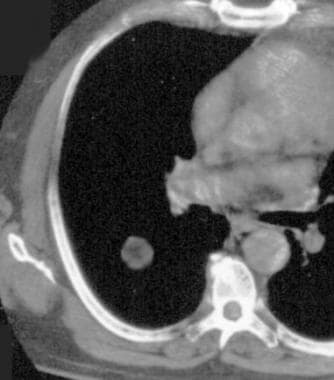 Nonenhanced, axial computed tomography (CT) scan t