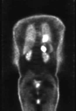 Lung cancer, small cell. Coronal positron emission