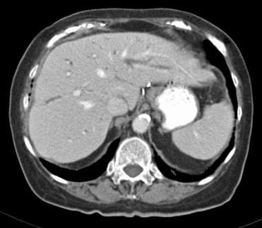 Caroli disease. CT image in a patient with biliary
