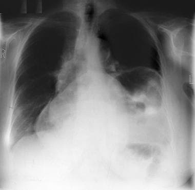A frontal chest radiograph in a patient with a lar