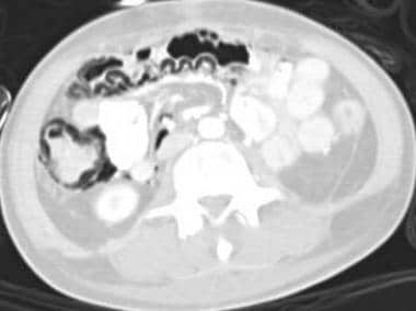 Mesenteric ischemia. CT scan in a 17-year-old male