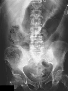Pneumoperitoneum. A 66-year-old man was admitted t