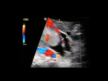 Color Doppler ultrasonography depicts a vasculariz