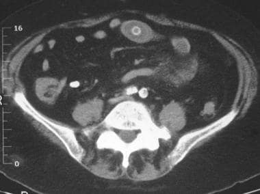 An enhanced axial CT scan at the level of the pelv