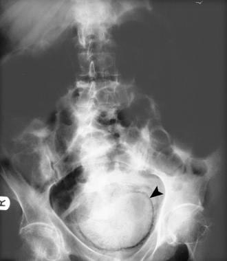 Plain radiograph in a 63-year-old patient with poo