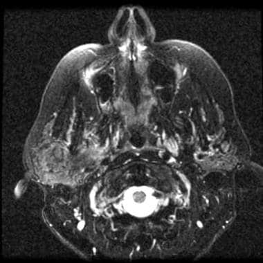 Parotid, malignant tumors. Axial T2-weighted MRI s