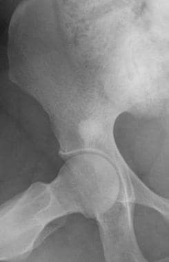 Plain film radiograph of the hip. The right iliac 
